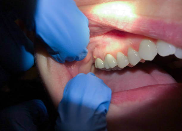 Best Dental Abscess Treatment in Canaan, CT